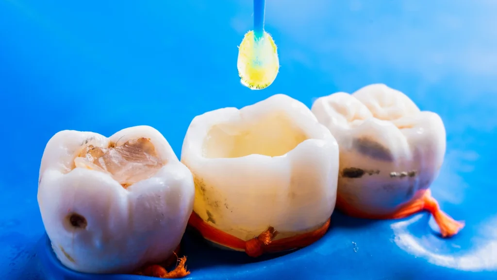 Ön Diş Dolgusu Nasıl Yapılır? Kulanım Ömrü Nedir?