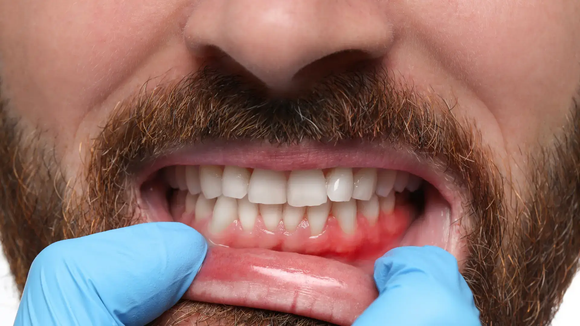 Pembe Estetik (Diş Eti Estetiği) Nedir? Kimlere Yapılır?